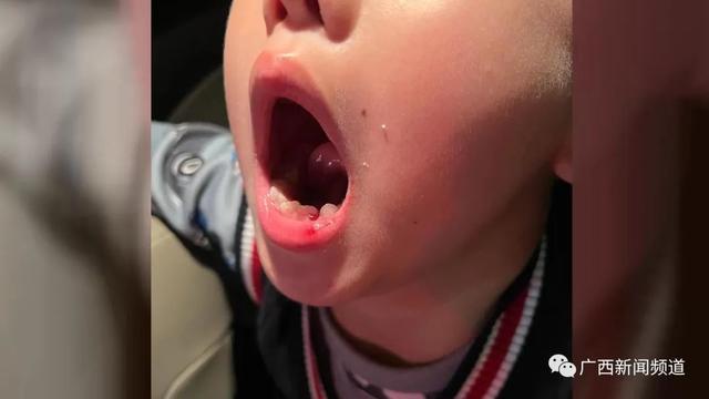 南寧6歲男童被鋼琴老師扇掉一顆牙，老師：正常教學而已